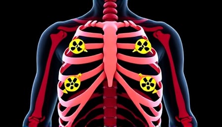 RaySearch Unveils RayCare v2025: Revolutionizing Oncology with Advanced Integration and Workflow Enhancements